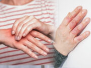 क्या जलने पर तुरंत लगाना चाहिए टूथपेस्ट, जानें ऐसे ही कुछ आम मिथक और उनका सच 1