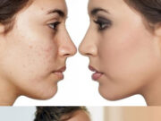 नहीं चाहिए चेहरे पर दाग-धब्बे और पिंपल्स, तो टाइप टाइप के हिसाब से करें उसकी केयर 1