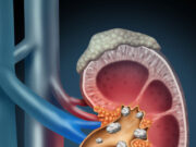 Kidney Stone Dissolving Food: किडनी में छिपी दर्दनाक पथरियों को ढूंढ-ढूंढकर घोल देती हैं ये 6 चीजें 1