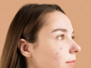 क्या पर्याप्त पानी पीने से दूर हो सकते हैं कील-मुंहासे? जानें एक्सपर्ट की राय 1