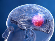 समय रहते पहचानें Brain Stroke के लक्षणों को, जरूरी प्राथमिक उपचार से बचाई जा सकती हैं व्यक्ति की जान 1