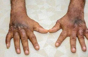 काशीपुर में कुष्ठ रोग पर नहीं लग पा रहा नियंत्रण, मरीजों की संख्या बढ़ी; 16 रोगियों का चल रहा इलाज