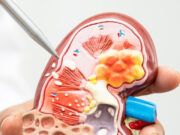 कहीं आप भी तो नहीं कर रहे ये गलती? किडनी स्टोन में ये 6 चीजें बढ़ा सकती हैं दर्द 7