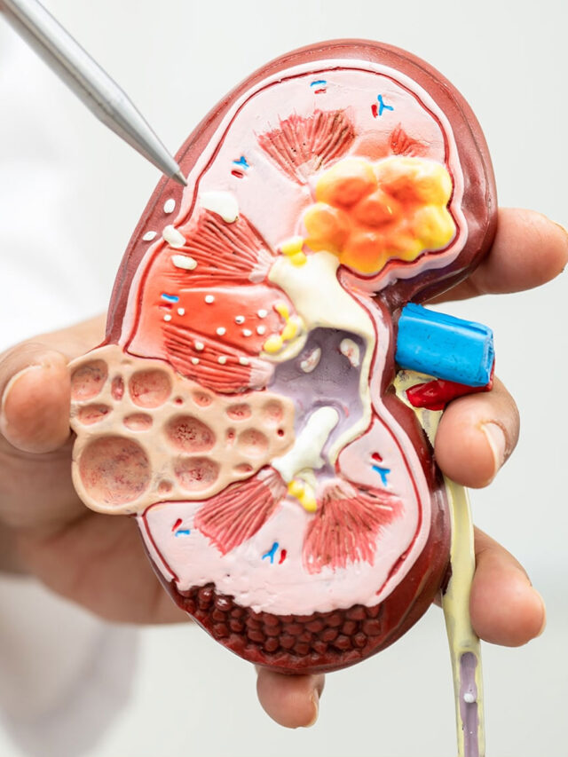 कहीं आप भी तो नहीं कर रहे ये गलती? किडनी स्टोन में ये 6 चीजें बढ़ा सकती हैं दर्द